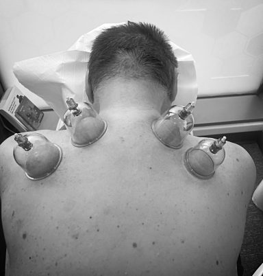 Dry cupping